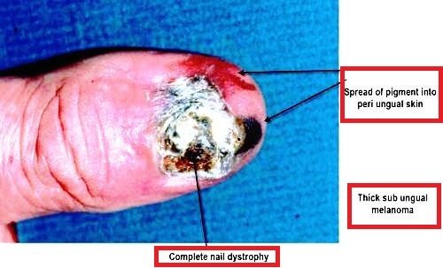 subungual melanoma pictures