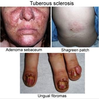 tuberous sclerosis pic