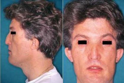 Craniodiaphyseal Dysplasia image