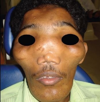 Craniodiaphyseal Dysplasia pic