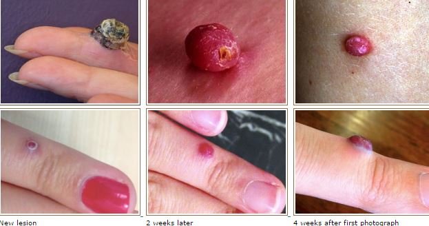 Pyogenic granuloma images