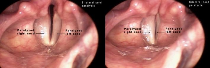 bilateral vocal cord paralysis