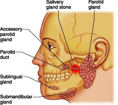 blocked salivary gland salivary stone image