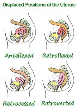 displaced positions of uterus