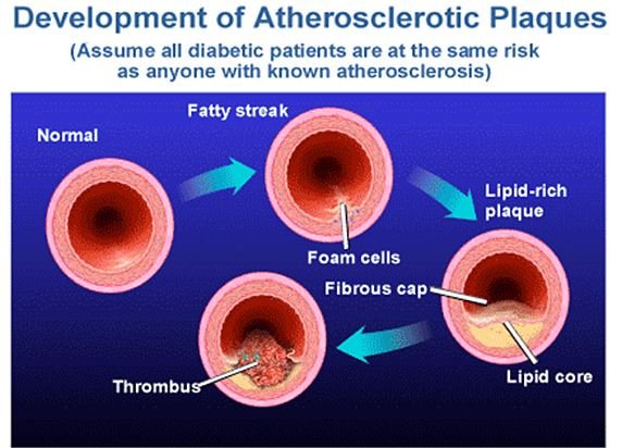 Dyslipidemia Definition Icd9 Code Guidelines What Is 0998