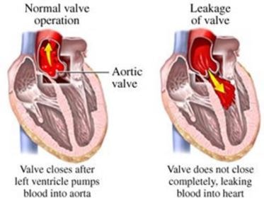 leaky heart valve