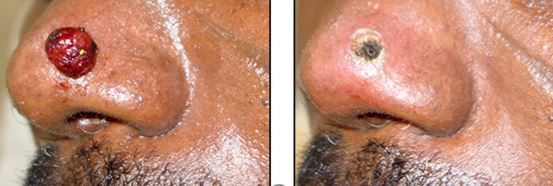 pyogenic granuloma before and after removal