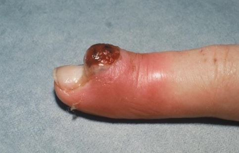 pyogenic granuloma finger