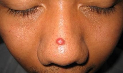 pyogenic granuloma nose