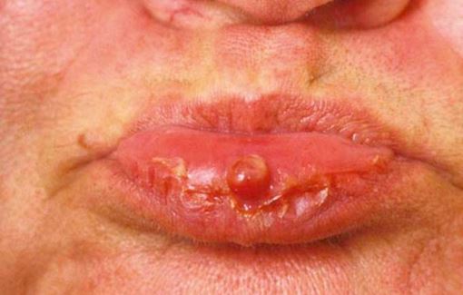 pyogenic granuloma on tongue