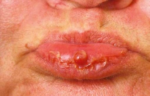 Pyogenic Granuloma Condition, Treatments, and Pictures for ...