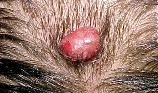 pyogenic granuloma scalp
