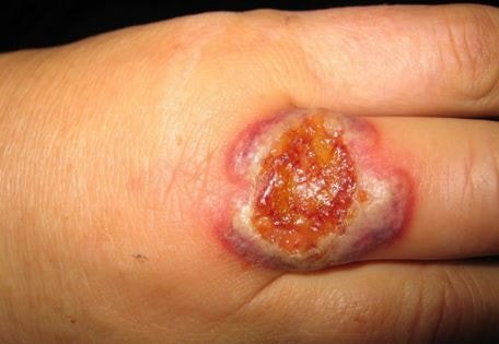 granuloma pyogenic removal unpleasant recommended disease below