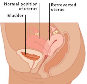 retroverted uterus image