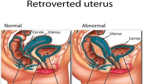 retroverted uterus photo