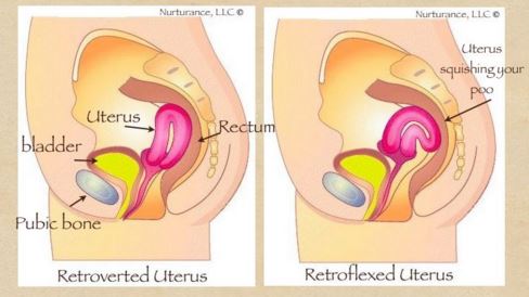 retroverted vs retroflexed uterus