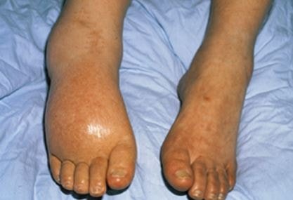 rsd disease image