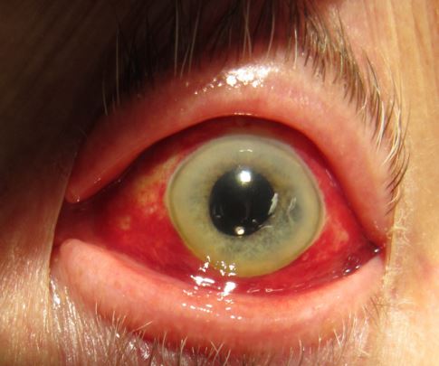 Broken Blood Vessels in the Eye - Causes, Treatment, Symptom