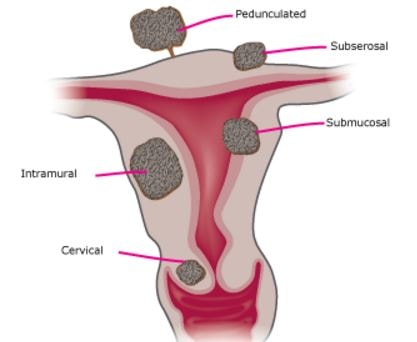 subserosal fibroid