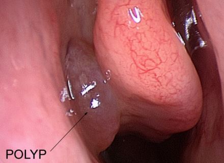 throat polpy on endoscopy laryngoscope