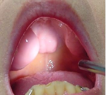 throat polyp image