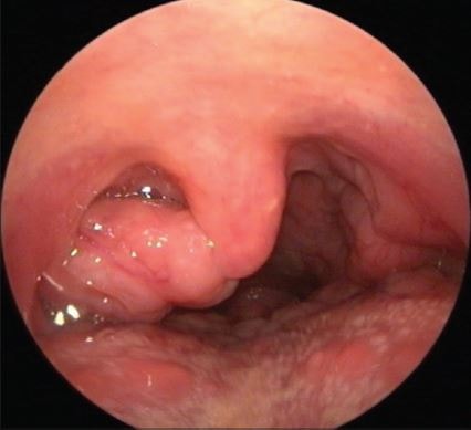 throat polyp pic