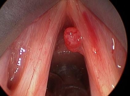 throat polyps