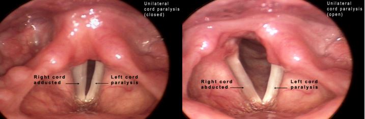 unilateral vocal cord paralysis left