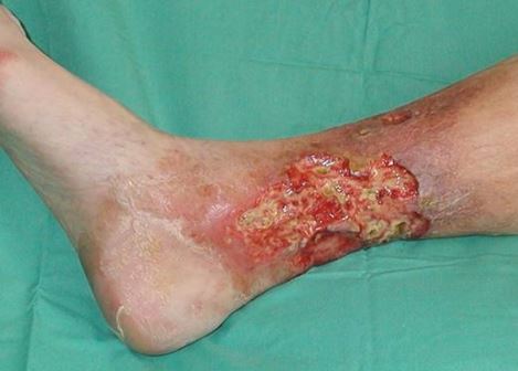 varicose ulcer picture