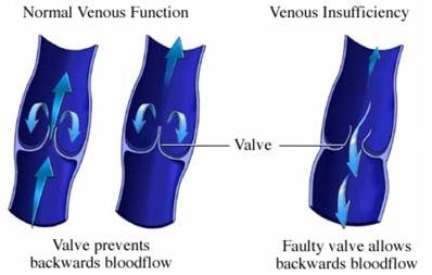 venous insufficiency