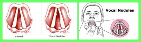 vocal nodules image