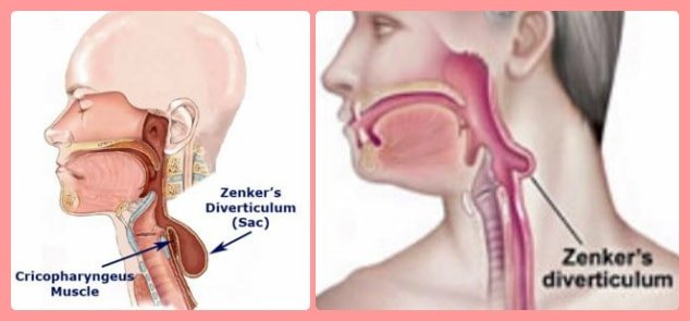 Pharyngeal Pouches Definition Symptoms Treatment