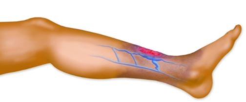 Blood clot in leg image