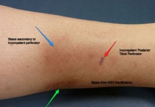 Blood clot in leg pathogenesis