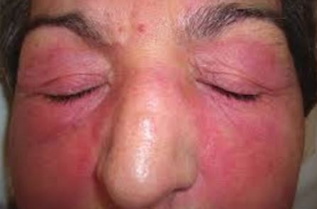 Heliotrope rash | definition of heliotrope rash by Medical ...