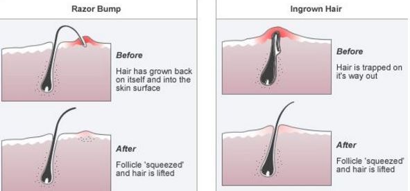Ingrown hair Vs razor bump before and after treatment
