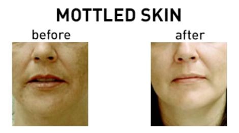 Mottled skin before after treatment