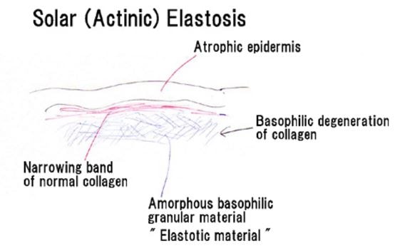 Solar elastosis pathophysiology