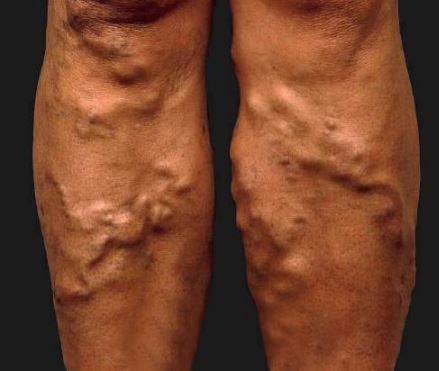 blood clot in legs images