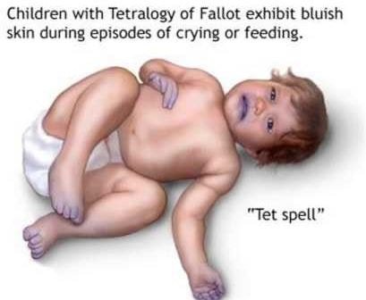 circum oral cyanosis bluish spell tetraology of fallot