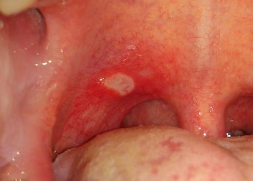 Aphthous Ulcers throat