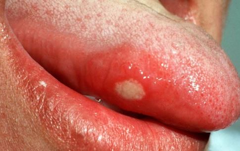 Aphthous ulcer side of tongue