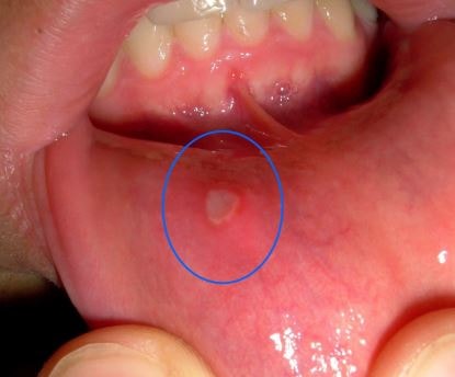 Aphthous ulcer lower lips