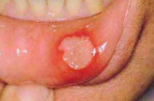 Aphthous ulcers lower lip