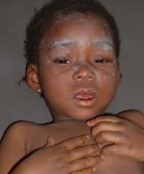German Measles Images 3
