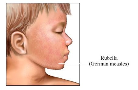 German measles pictures-