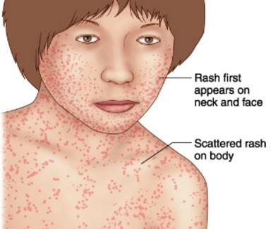 German measles rash image on body 4