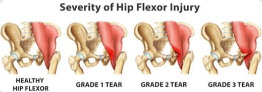 Hip Flexor pain causes strain