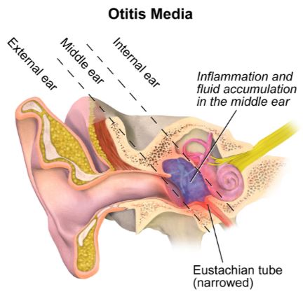 Otitis Media Anatomy symptoms
