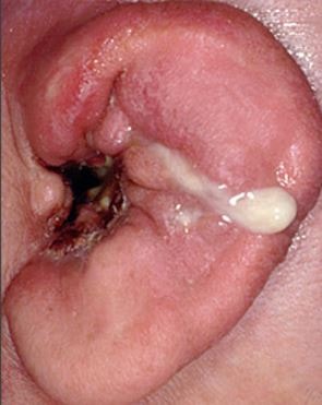 Outer ear infection pus otitis externa swimmers ear